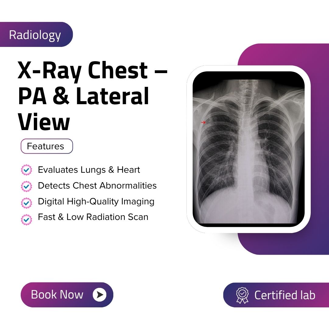 X-Ray Chest – PA & Lateral View